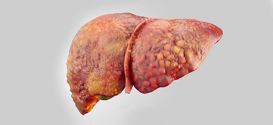 ไขมันพอกตับคืออะไร?